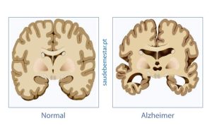 livro sobre doenÃ§a Alzheimer